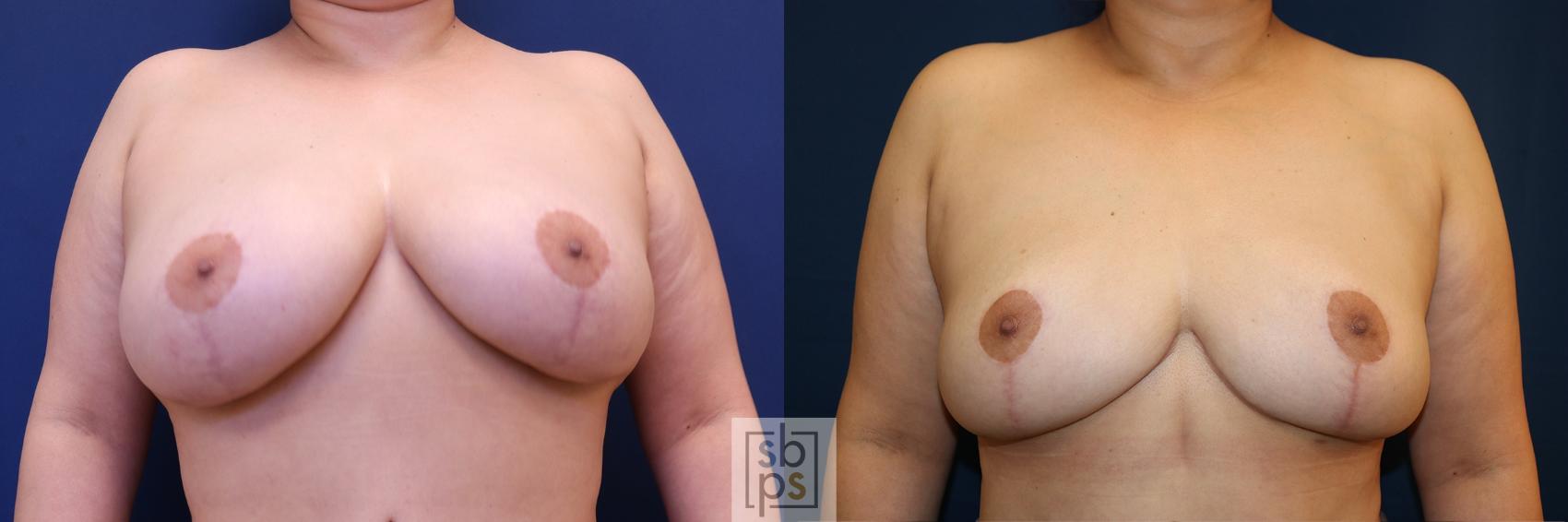 Before & After Breast Reduction Case 619 Front View in Torrance, CA