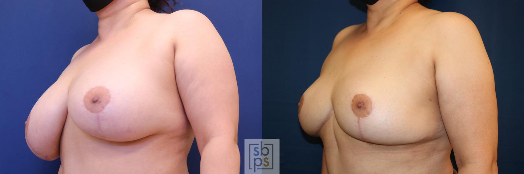 Before & After Breast Reduction Case 619 Left Oblique View in Torrance, CA