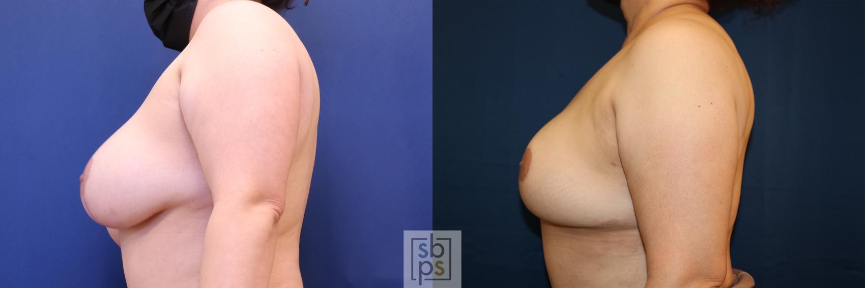 Before & After Breast Reduction Case 619 Left Side View in Torrance, CA