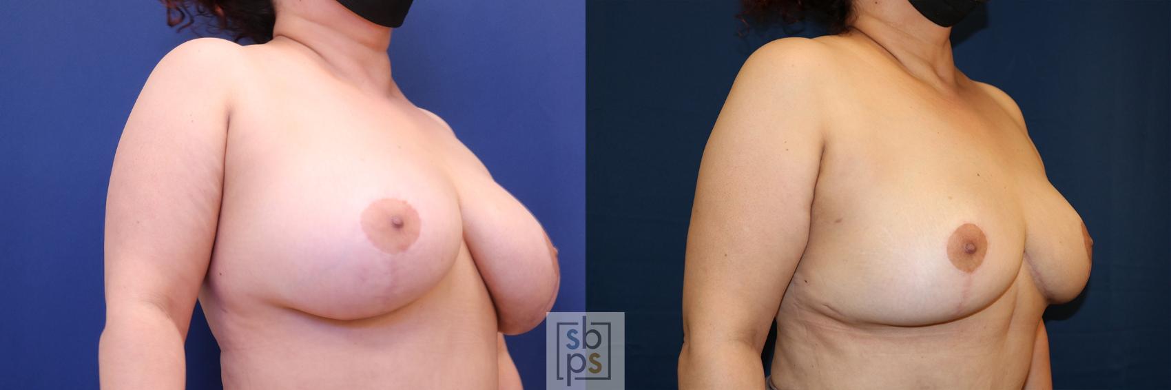 Before & After Breast Reduction Case 619 Right Oblique View in Torrance, CA