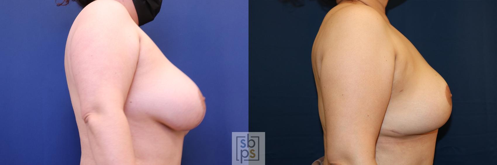 Before & After Breast Reduction Case 619 Right Side View in Torrance, CA