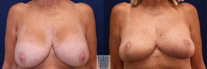 Before & After Breast Reduction Case 621 Front View in Torrance, CA