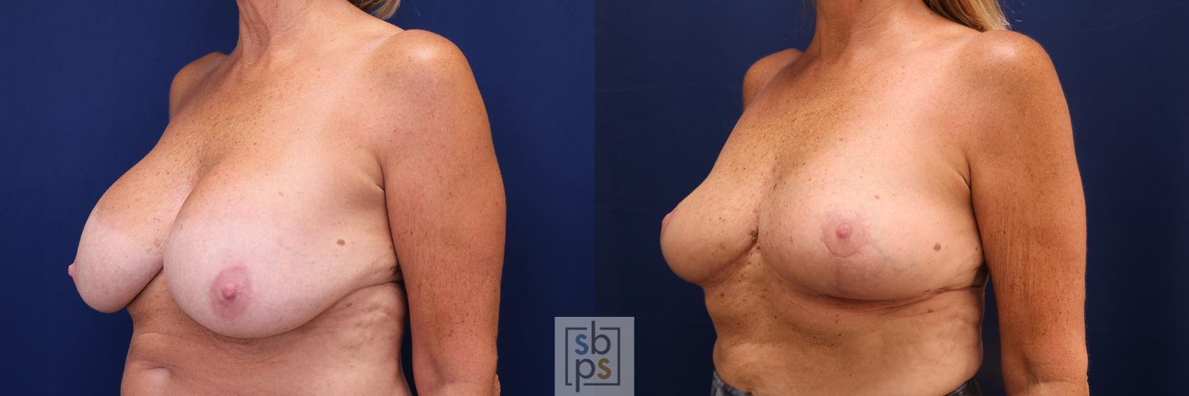 Before & After Breast Reduction Case 621 Left Oblique View in Torrance, CA