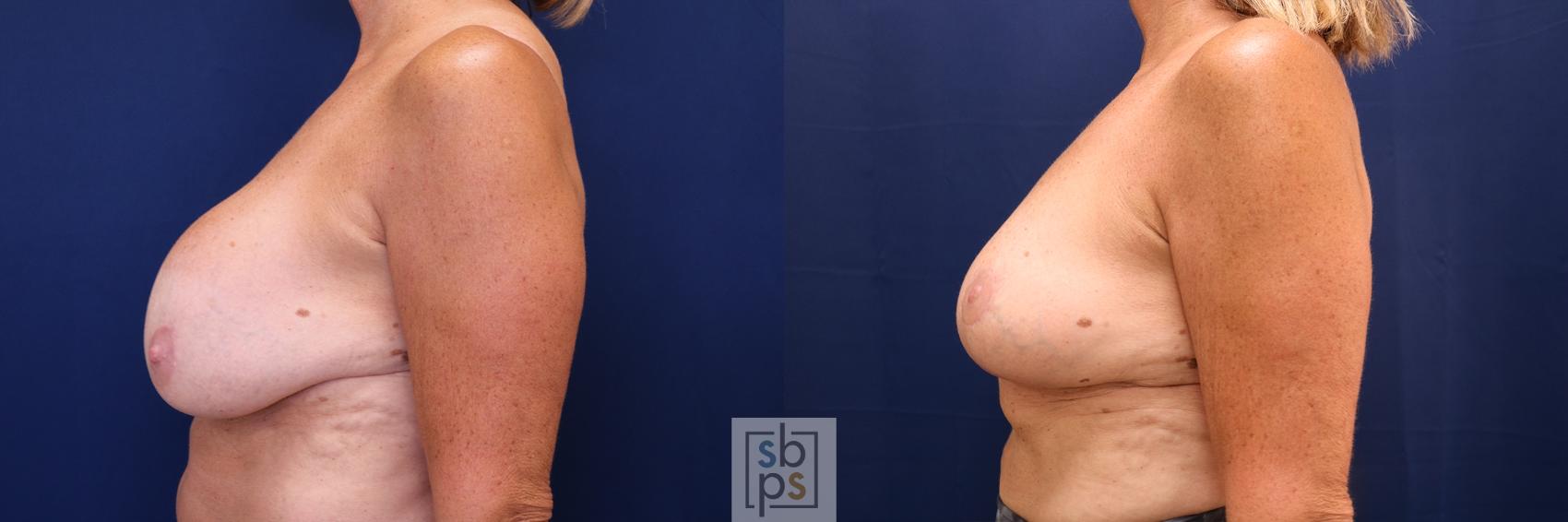 Before & After Breast Reduction Case 621 Left Side View in Torrance, CA