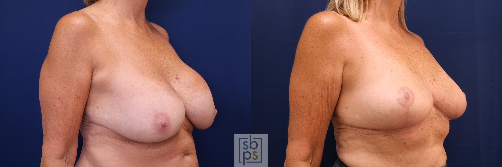 Before & After Breast Reduction Case 621 Right Oblique View in Torrance, CA