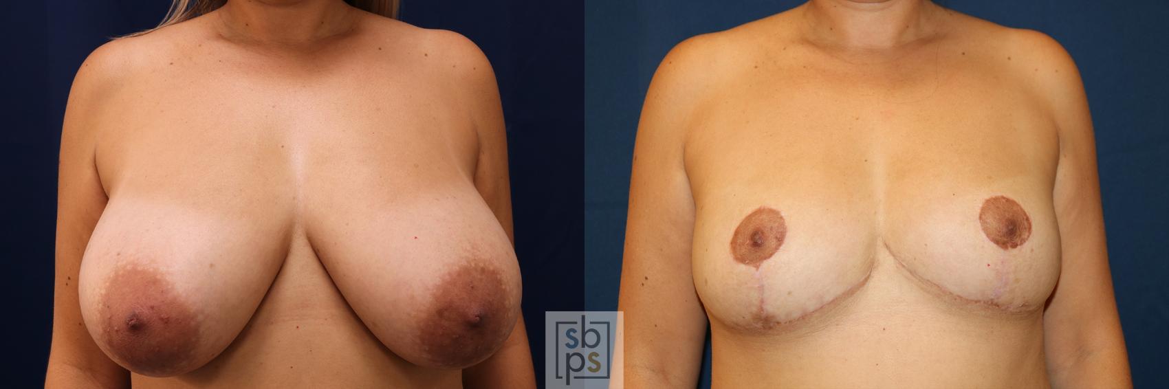 Before & After Breast Reduction Case 624 Front View in Torrance, CA