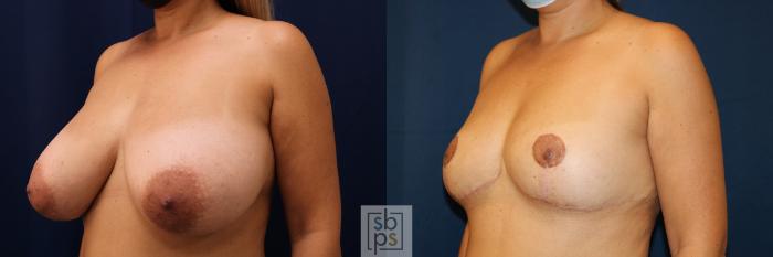 Before & After Breast Reduction Case 624 Left Oblique View in Torrance, CA