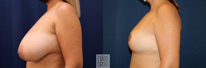 Before & After Breast Reduction Case 624 Left Side View in Torrance, CA