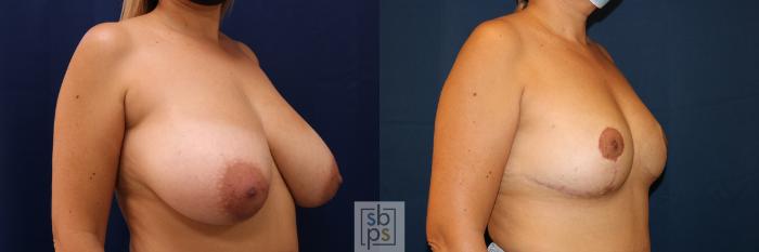 Before & After Breast Reduction Case 624 Right Oblique View in Torrance, CA