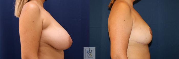 Before & After Breast Reduction Case 624 Right Side View in Torrance, CA