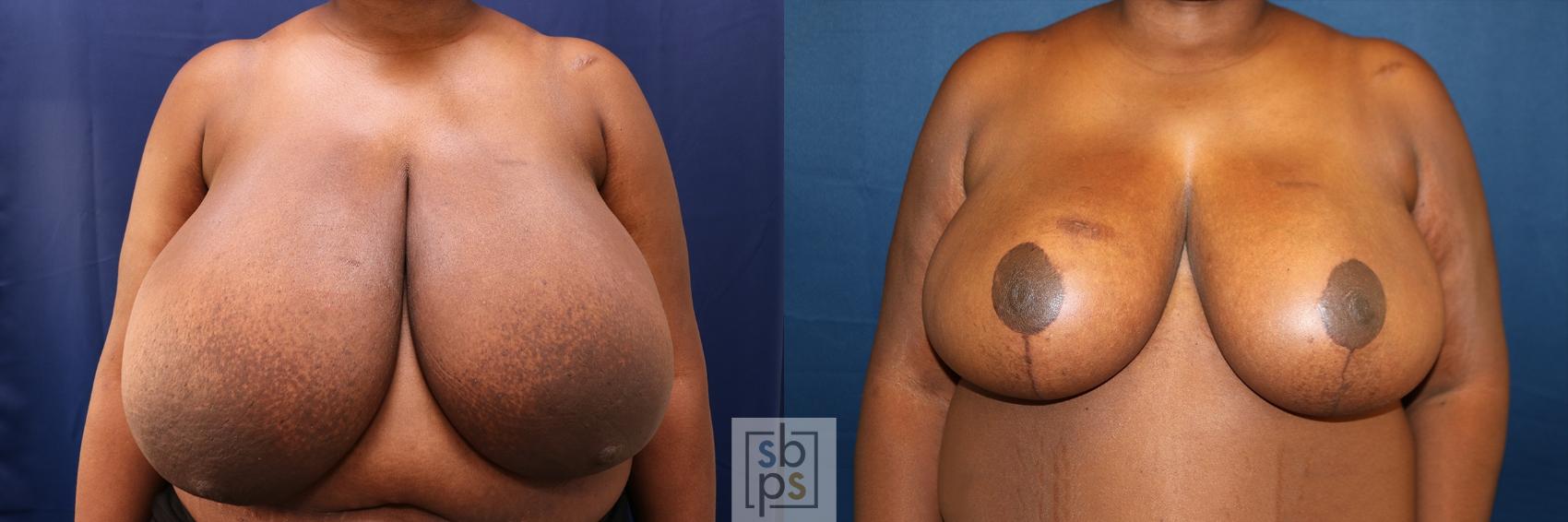 Before & After Breast Reduction Case 625 Front View in Torrance, CA