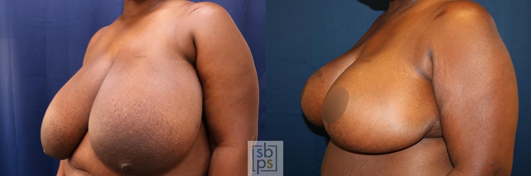 Before & After Breast Reduction Case 625 Left Oblique View in Torrance & Los Angeles, CA, CA
