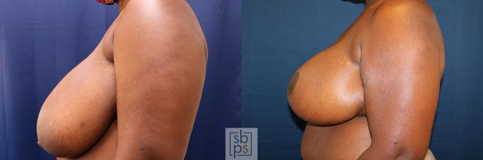 Before & After Breast Reduction Case 625 Left Side View in Torrance, CA