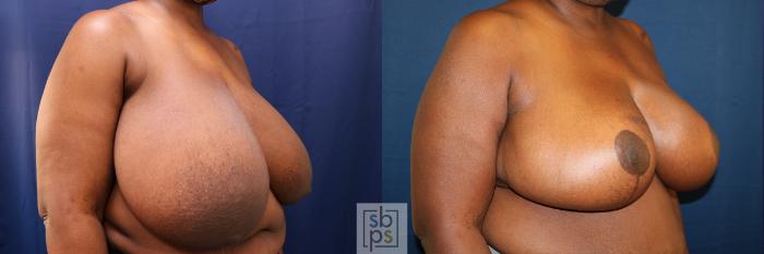 Before & After Breast Reduction Case 625 Right Oblique View in Torrance, CA