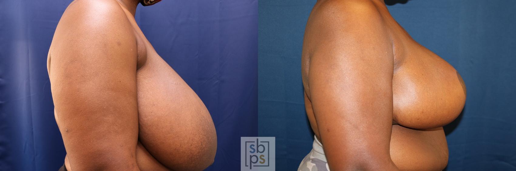 Before & After Breast Reduction Case 625 Right Side View in Torrance & Los Angeles, CA, CA