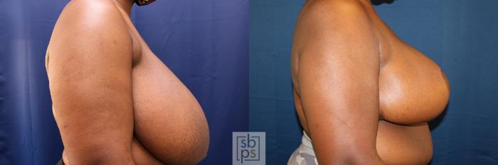 Before & After Breast Reduction Case 625 Right Side View in Torrance, CA