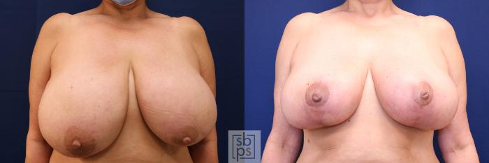 Before & After Breast Reduction Case 632 Front View in Torrance, CA