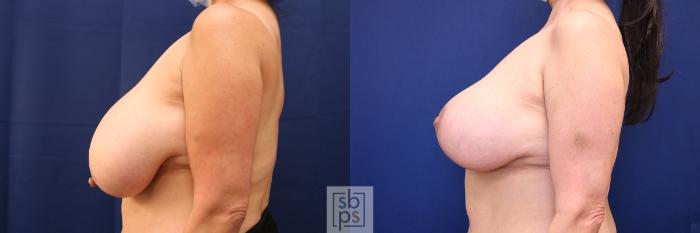 Before & After Breast Reduction Case 632 Left Side View in Torrance, CA