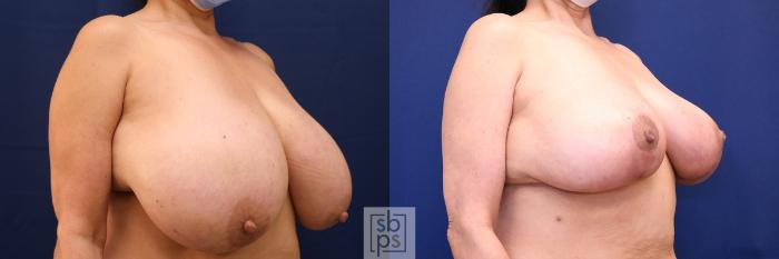 Before & After Breast Reduction Case 632 Right Oblique View in Torrance, CA