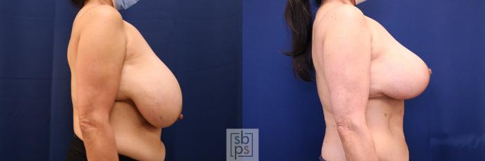 Before & After Breast Reduction Case 632 Right Side View in Torrance, CA