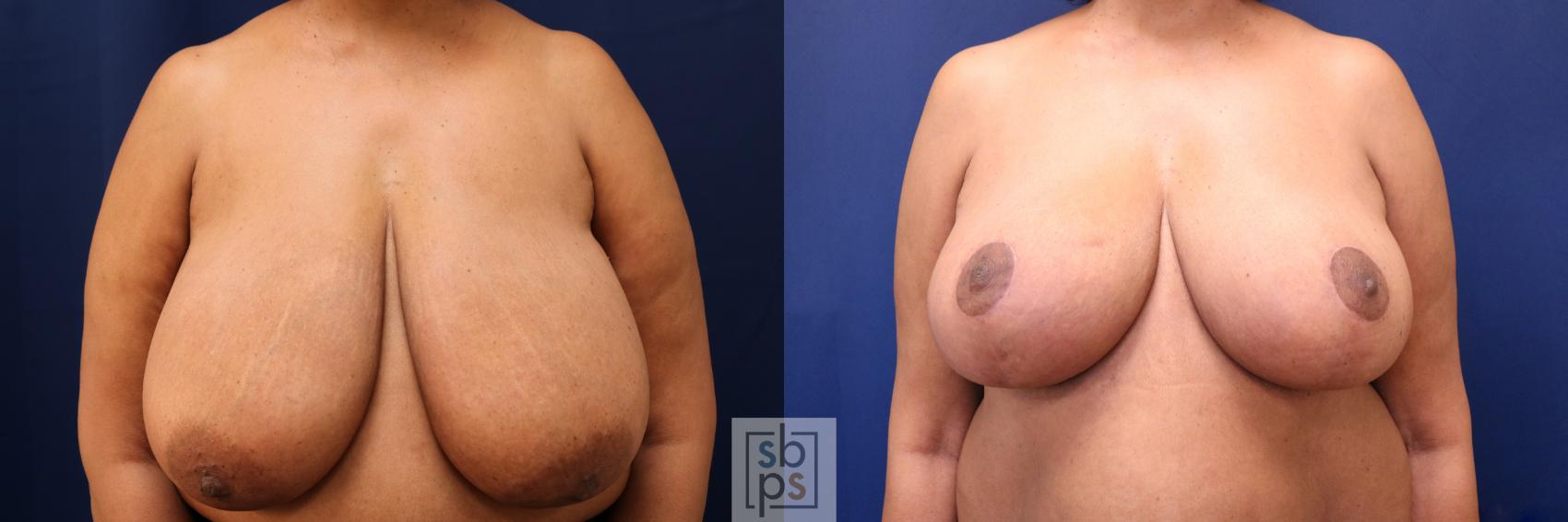 Before & After Breast Reduction Case 633 Front View in Torrance, CA