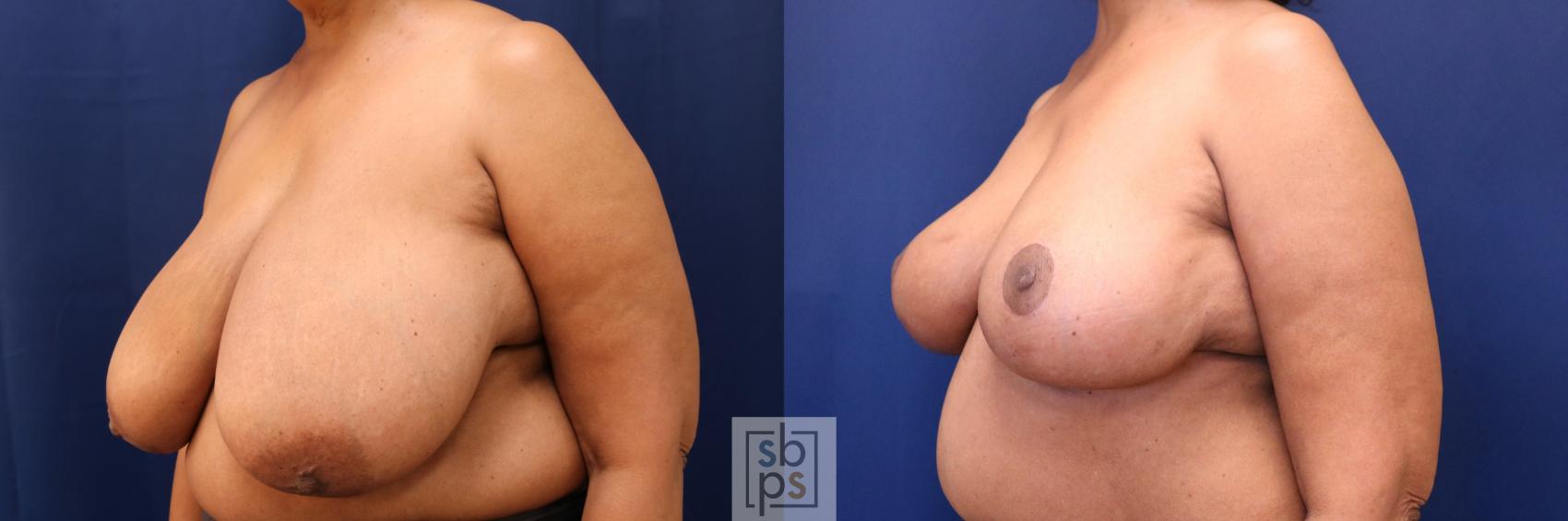 Before & After Breast Reduction Case 633 Left Oblique View in Torrance & Los Angeles, CA, CA
