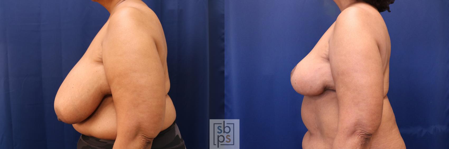 Before & After Breast Reduction Case 633 Left Side View in Torrance & Los Angeles, CA, CA