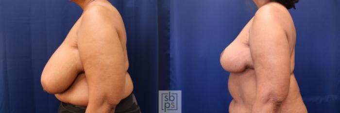 Before & After Breast Reduction Case 633 Left Side View in Torrance, CA