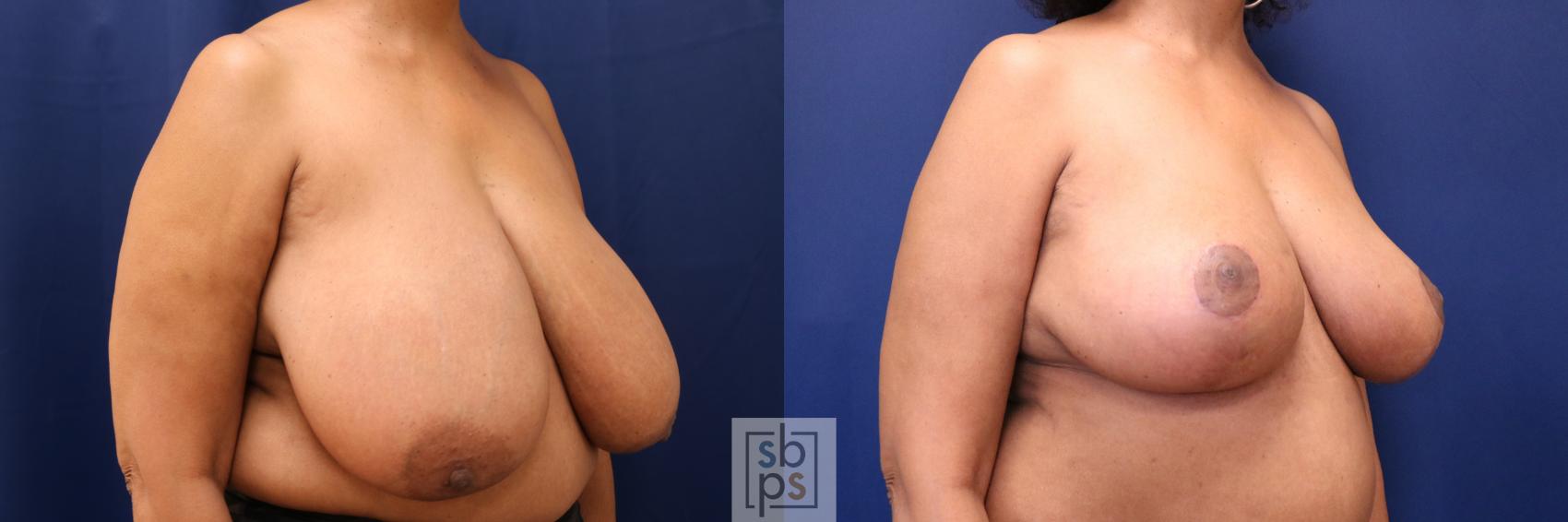 Before & After Breast Reduction Case 633 Right Oblique View in Torrance & Los Angeles, CA, CA