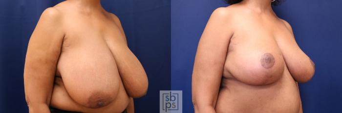 Before & After Breast Reduction Case 633 Right Oblique View in Torrance, CA