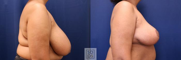 Before & After Breast Reduction Case 633 Right Side View in Torrance, CA