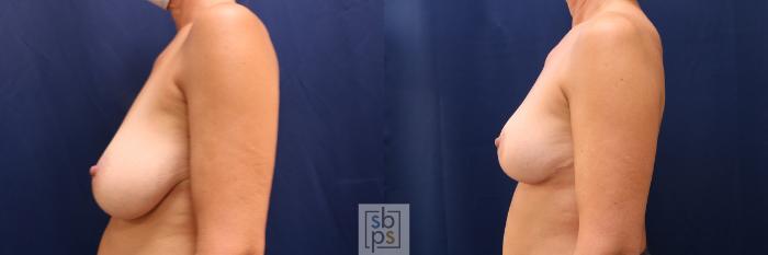 Before & After Breast Reduction Case 634 Left Side View in Torrance, CA