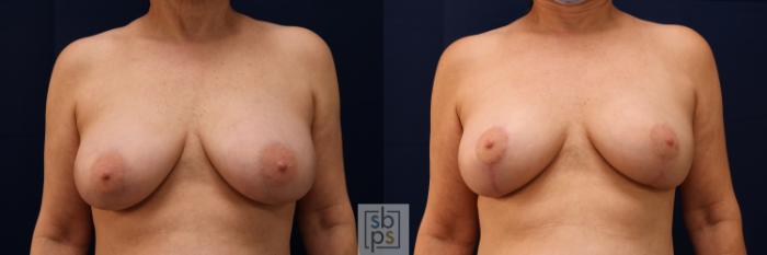 Before & After Breast Reduction Case 642 Front View in Torrance, CA