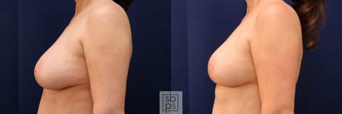 Before & After Breast Reduction Case 642 Left Side View in Torrance, CA