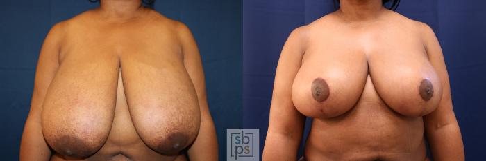 Before & After Breast Reduction Case 645 Front View in Torrance, CA