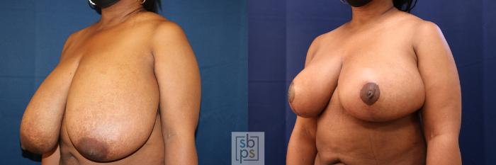 Before & After Breast Reduction Case 645 Left Oblique View in Torrance, CA