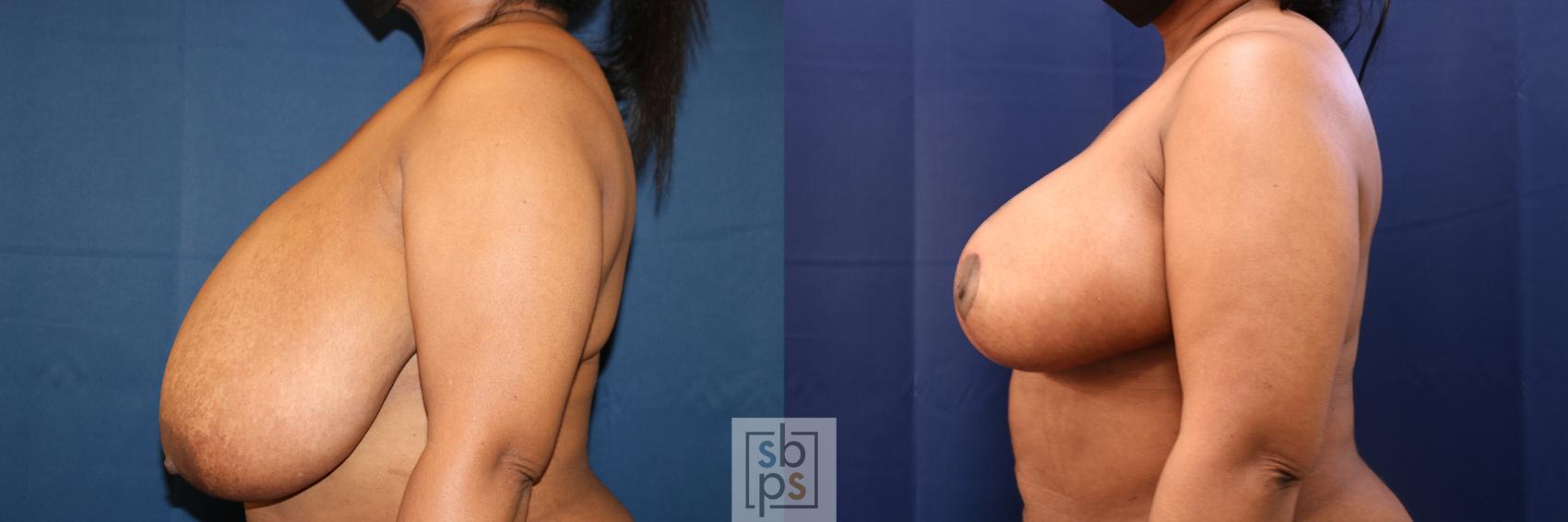 Before & After Breast Reduction Case 645 Left Side View in Torrance & Los Angeles, CA, CA