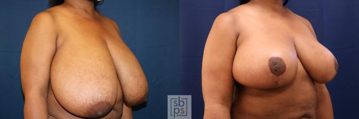 Before & After Breast Reduction Case 645 Right Oblique View in Torrance, CA