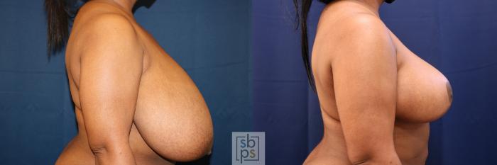 Before & After Breast Reduction Case 645 Right Side View in Torrance, CA