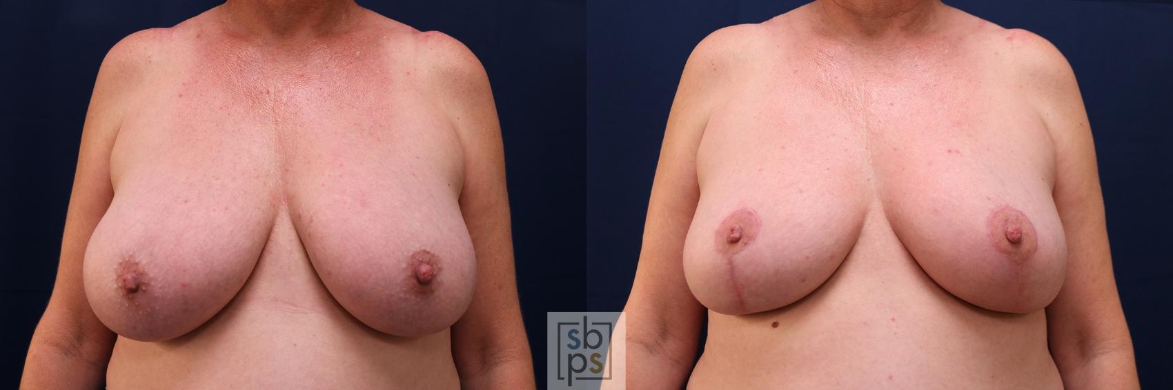 Before & After Breast Reduction Case 655 Front View in Torrance, CA