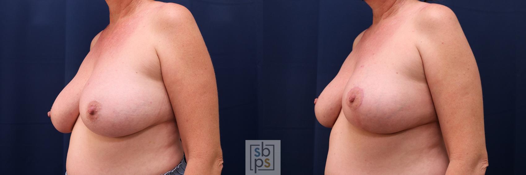Before & After Breast Reduction Case 655 Left Oblique View in Torrance & Los Angeles, CA, CA