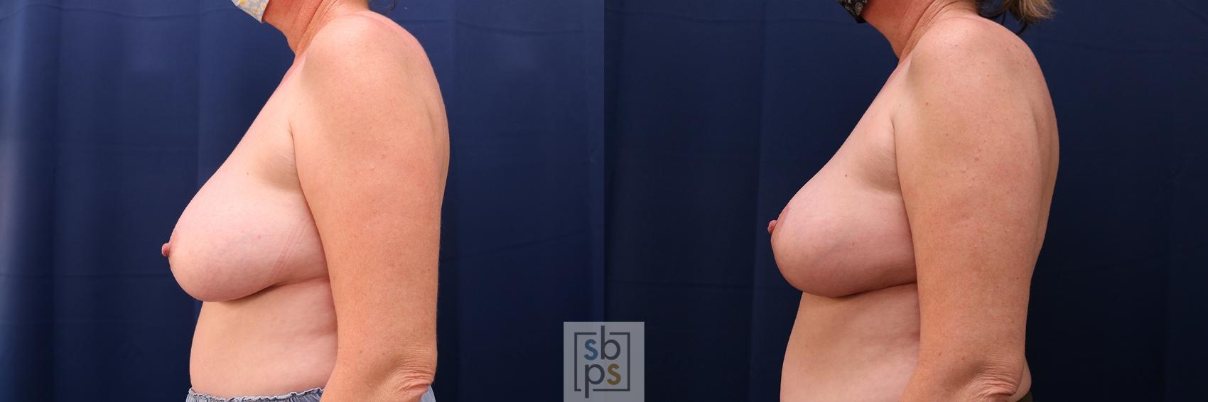 Before & After Breast Reduction Case 655 Left Side View in Torrance & Los Angeles, CA, CA