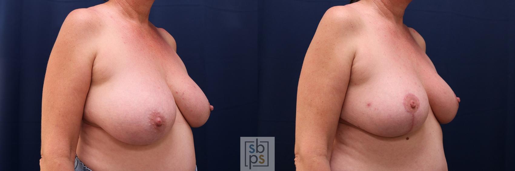 Before & After Breast Reduction Case 655 Right Oblique View in Torrance & Los Angeles, CA, CA