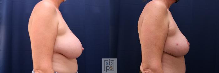Before & After Breast Reduction Case 655 Right Side View in Torrance, CA