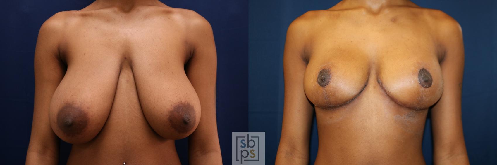 Before & After Breast Reduction Case 659 Front View in Torrance, CA