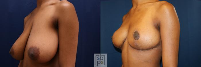 Before & After Breast Reduction Case 659 Left Oblique View in Torrance, CA