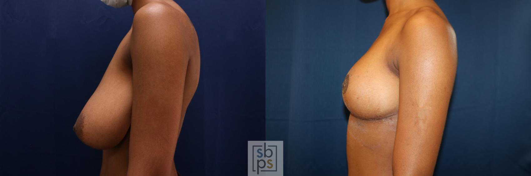 Before & After Breast Reduction Case 659 Left Side View in Torrance & Los Angeles, CA, CA