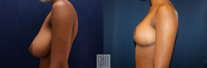 Before & After Breast Reduction Case 659 Left Side View in Torrance, CA