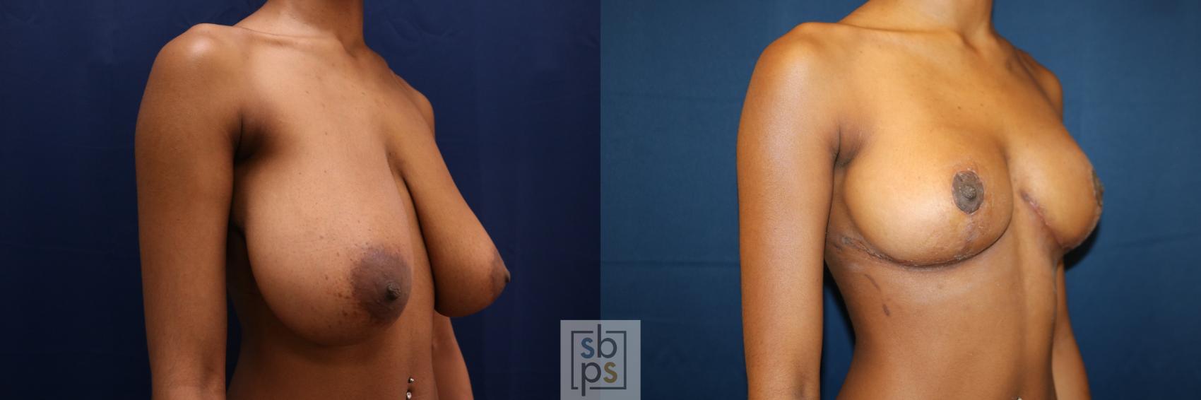 Before & After Breast Reduction Case 659 Right Oblique View in Torrance & Los Angeles, CA, CA