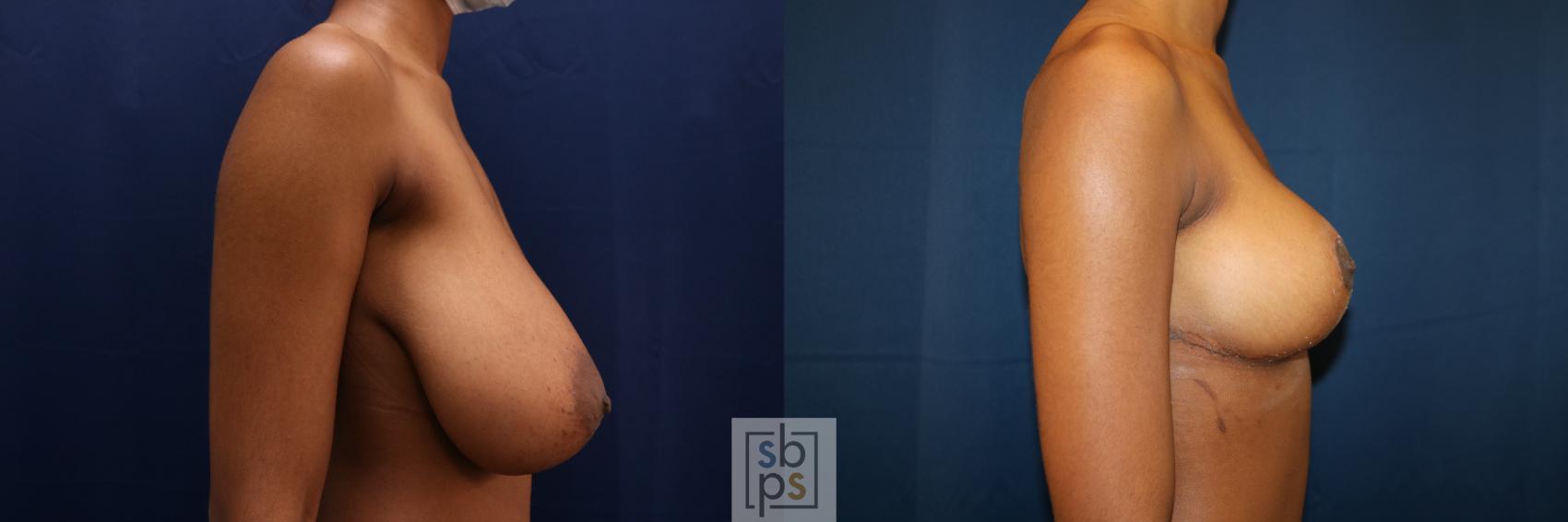 Before & After Breast Reduction Case 659 Right Side View in Torrance & Los Angeles, CA, CA